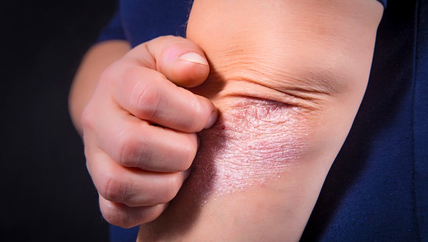 Ny studie om psoriasis och vitiligo – öppnar upp för nya behandlingar